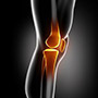 Robotic Assisted Partial Knee Surgery